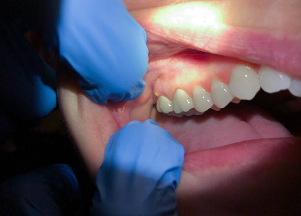 Best Chipped Tooth Repair Near Me  in Meadowdale, WA